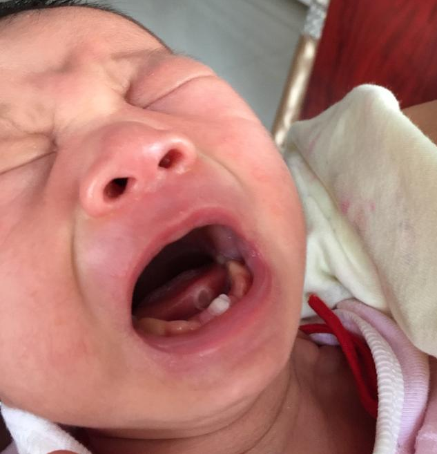 孩子嘴里的马牙能挑破吗 如何区分马牙和鹅口疮