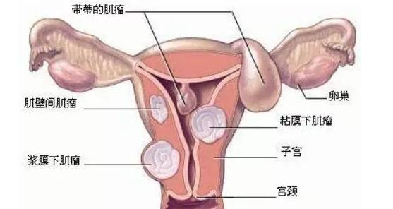 子宫发育不良能治愈吗 子宫发育不良不来月经怎么办