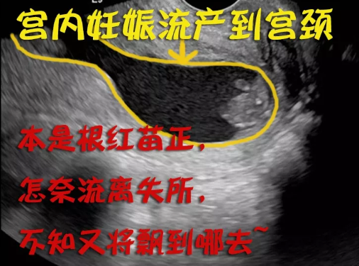 宫颈妊娠属于宫外孕吗 怎么看是不是宫颈妊娠症状