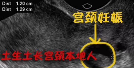 宫颈妊娠属于宫外孕吗 怎么看是不是宫颈妊娠症状