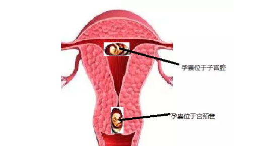 宫颈妊娠要做哪些检查 宫颈妊娠的临床表现症状