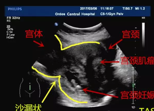 宫颈妊娠治疗难度大吗 宫颈妊娠妇科检查症状