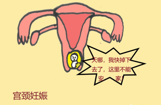 宫颈妊娠要做清宫手术吗 宫颈妊娠要做什么治疗最好